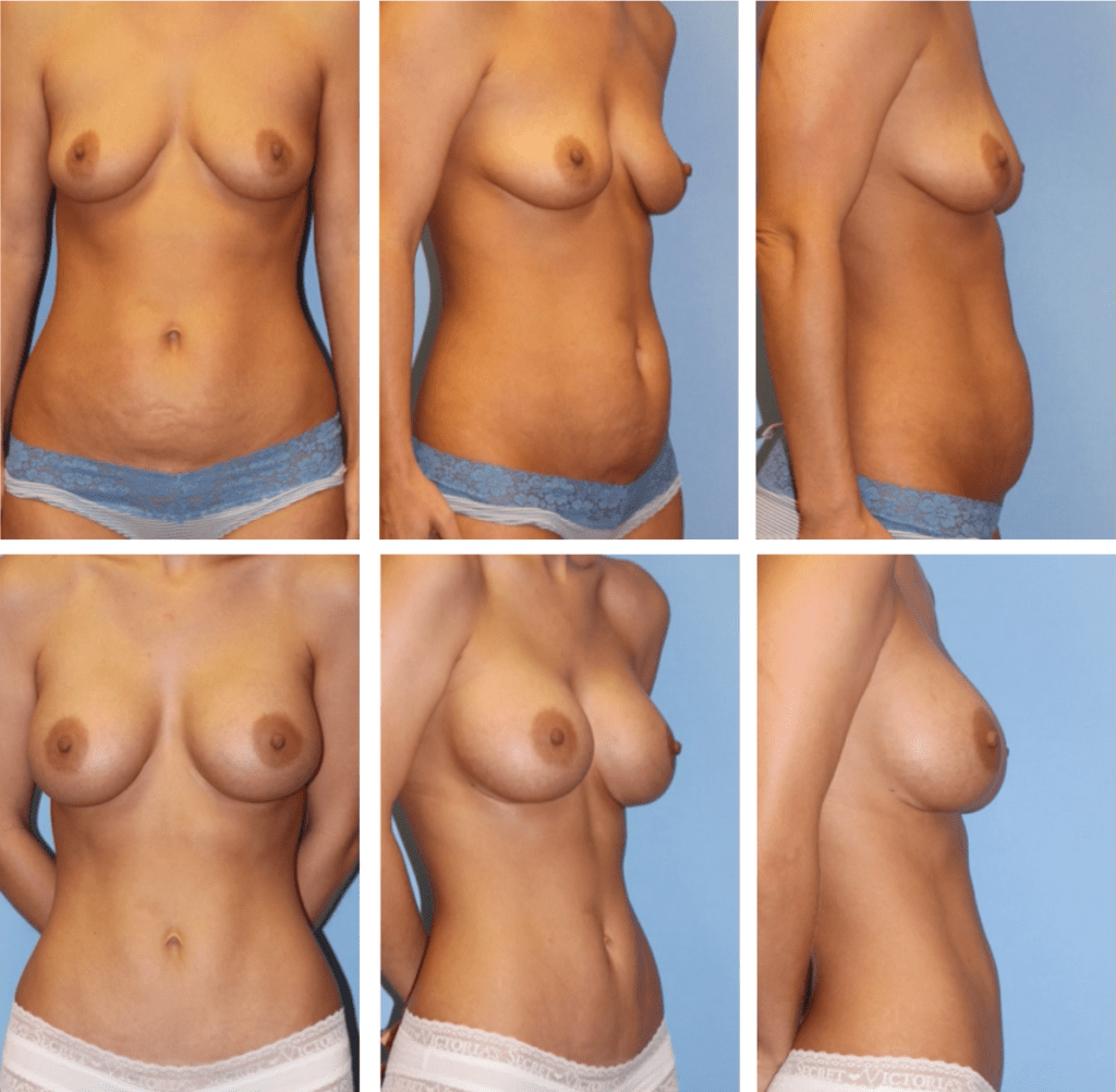 mommy-makeover-wtih-breast-augmentation-and-mini-tummy-tuck-dr-firouz-beverly-hills