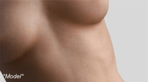 Breast-implant-rupture-repair-Beverly-Hills