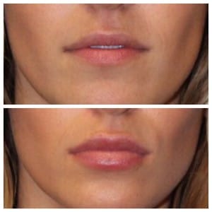 before-after-lip-augmentation