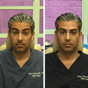 brotox-firouz-before-and-after