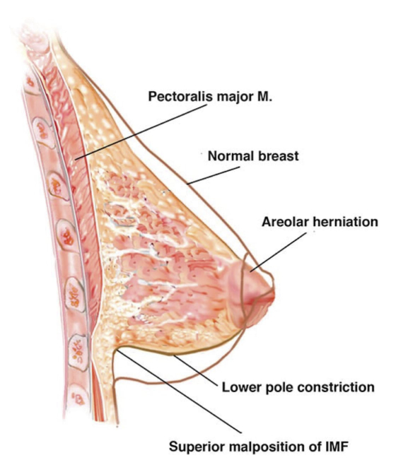 Asymmetric Tuberous Breast : Symptoms, Causes & Treatment